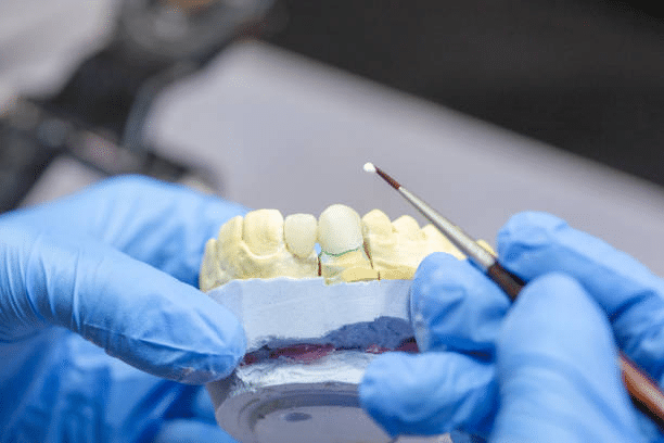 a dentist shaping a veneer on a mold of someones teeth