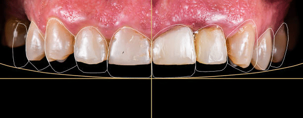 photo of the upper set of teeth with an outline of the ideal length and alignment of teeth