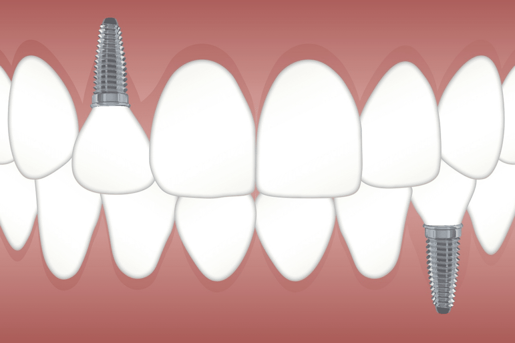 a digital illustration of dental implants installed into the jaw