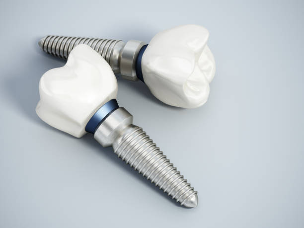 actual photo of a dental implant