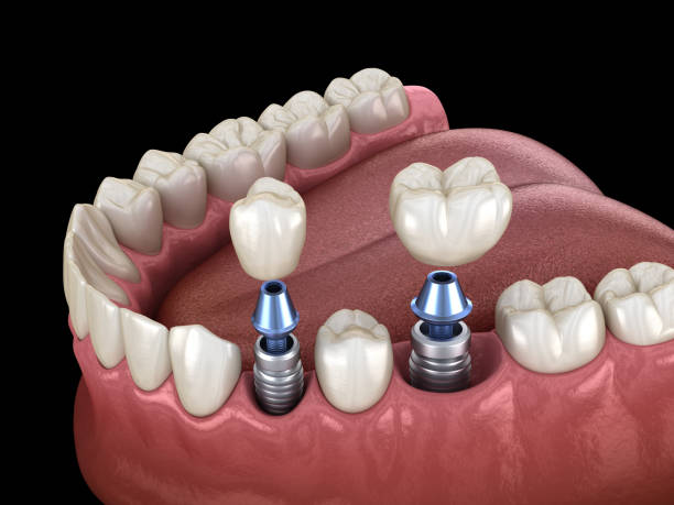 photo showing dental implants and how they are installed into the gums