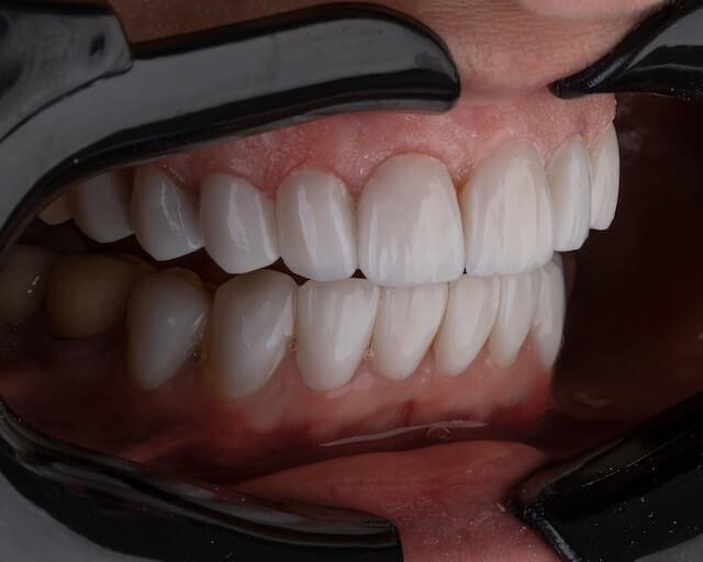 a close-up shot of a person's complete set of teeth