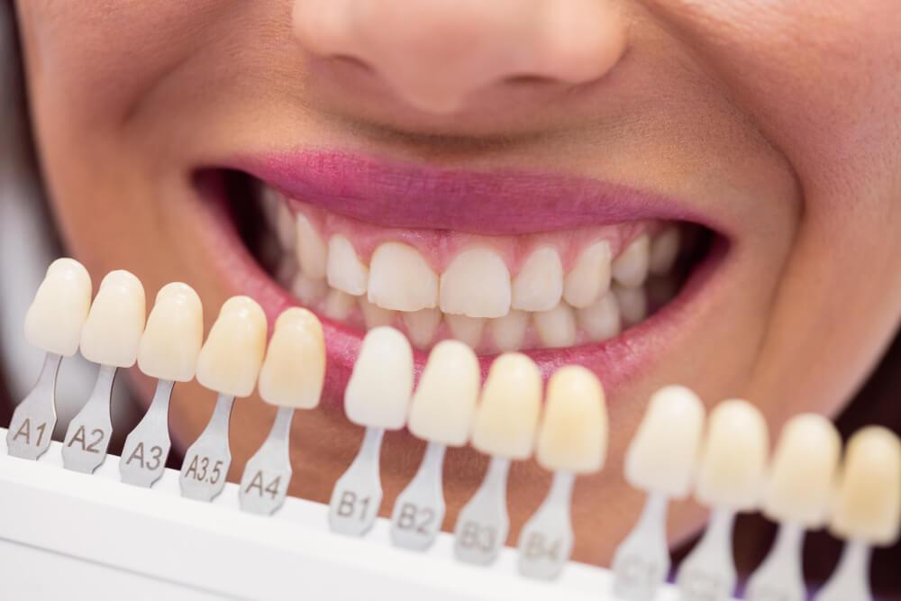 a palette of veneers shades in front of a woman's teeth