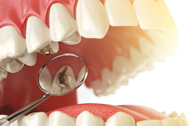 a digital illustration showing a decayed tooth through a dental mirror