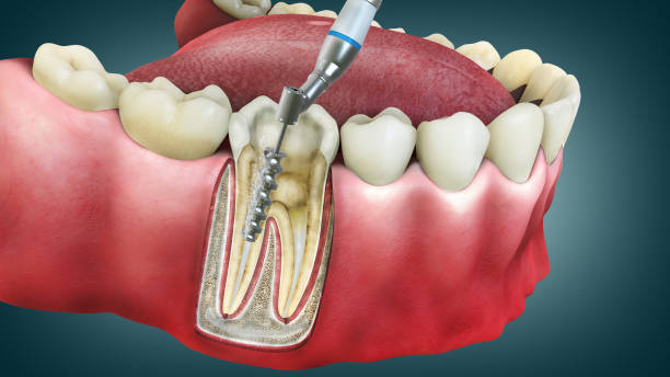 a digital image showing how a root canal procedure is done 