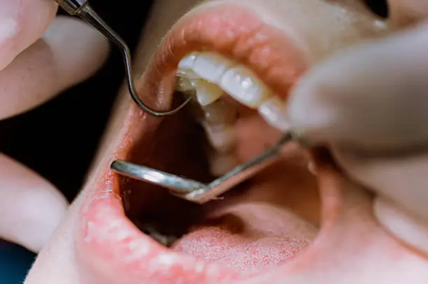 exposed tooth nerve