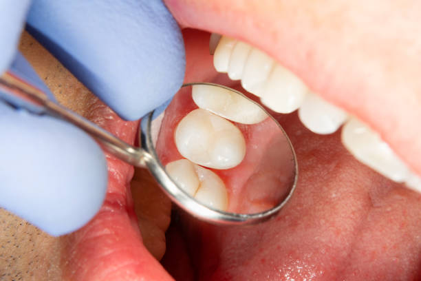 an image showing the natural looking fillings through the dental mirror