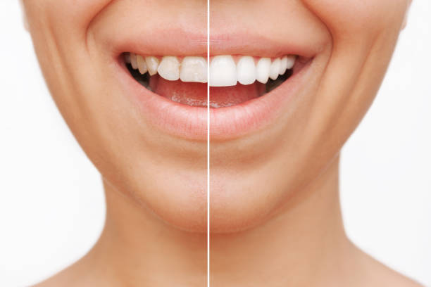 image of the before and after of teeth with veneers