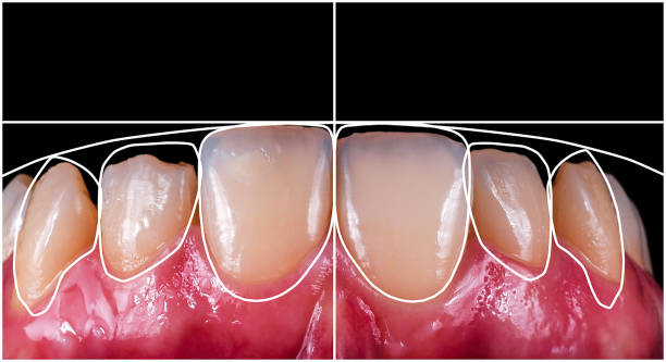 image showing how veneers can enhance your teeth appearance