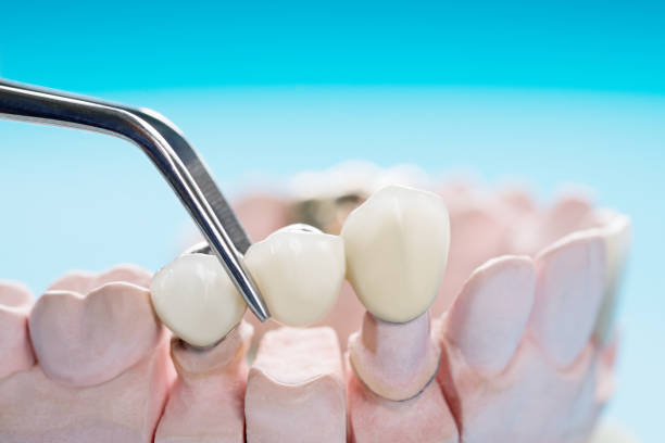 dental bridges placed by a dental tool