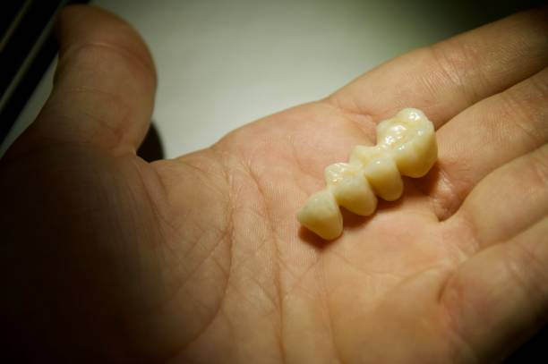 dental bridges on a hand