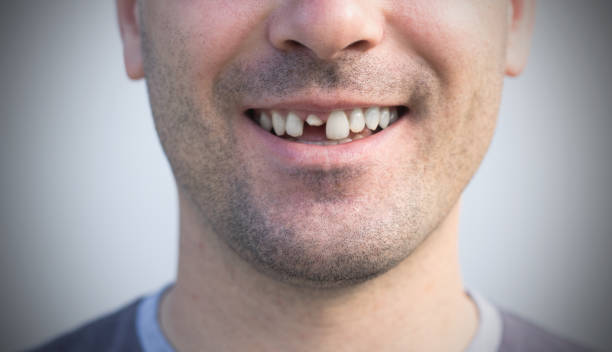 image of a man with a broken tooth