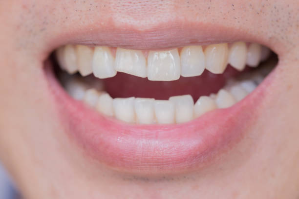 image of a person's uneven teeth